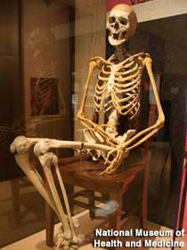 Skeleton fused into sitting position.