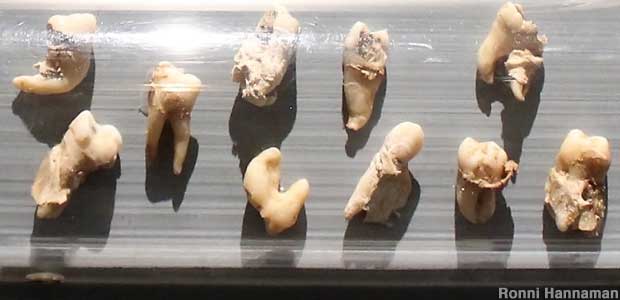 Terrifying teeth pulled from the mouths of Nevada prospectors.