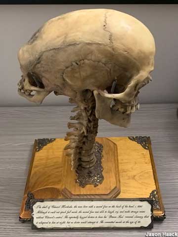The fused skull of Edward Mordrake.