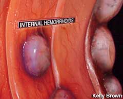 Internal Hemorrhoids.